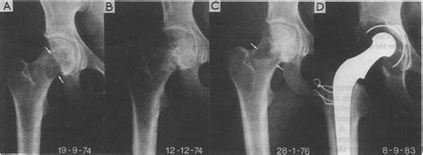 lytic lesion femoral neck.